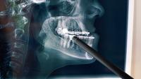 CT scan of teeth with braces in consultation with a maxillofacial surgeon.